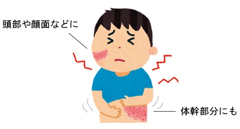 帯状疱疹